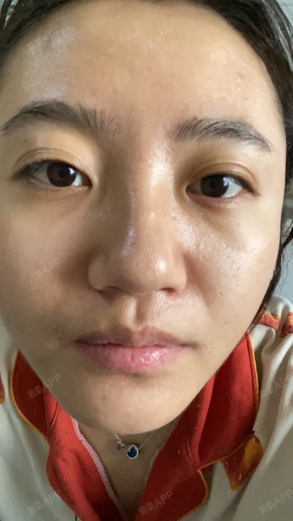 果酸焕肤项目术后第2天