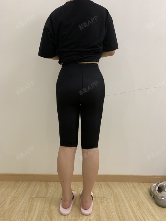 吸脂瘦大腿好不好_效果图_小仙oho吸脂瘦大腿术后第181天_新氧美容