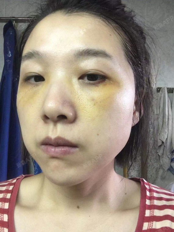 眶隔脂肪释放