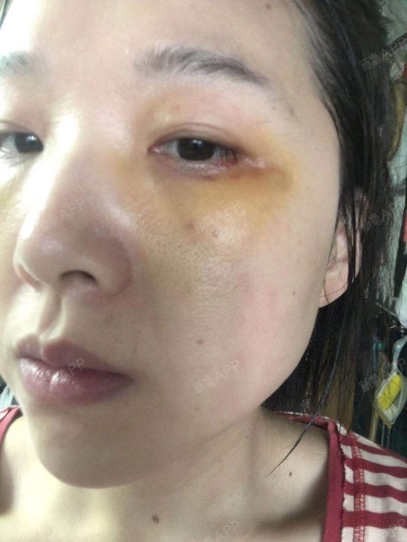 上海眶隔脂肪释放好不好_效果图_氧气26rhy眶隔脂肪释放术后第7天