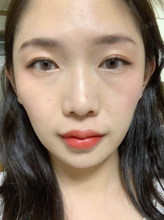 玻尿酸丰唇好不好_效果图_bella225_玻尿酸丰唇术后第1天_新氧美容