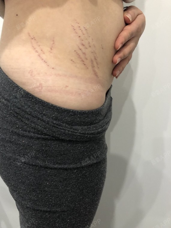 现在做完妊娠纹已经半个月了时间过的好快,现在就在等_圈子-新氧美容