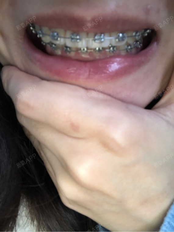 下排牙齿的变化