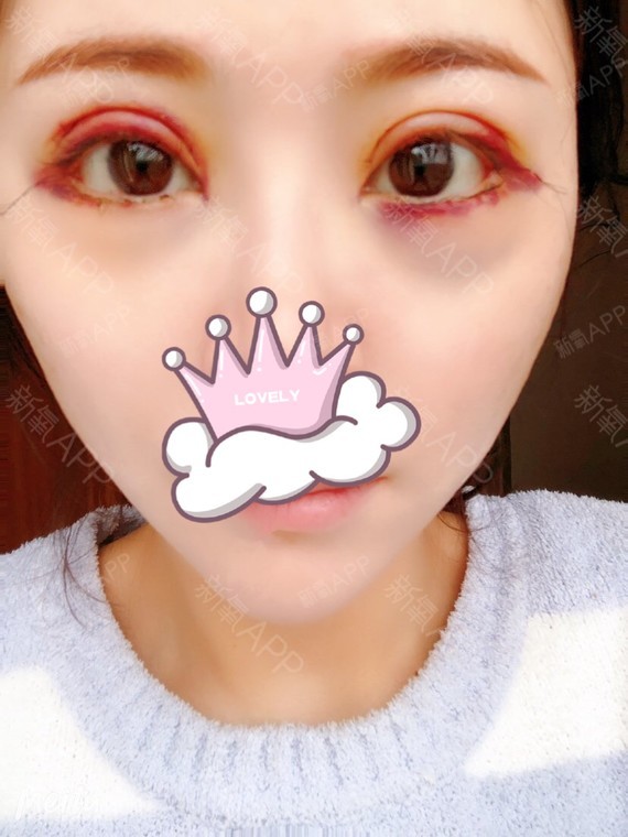 眼综合第六天 开后眼尾77下至和全切双眼皮 自然款 _圈子-新氧美容