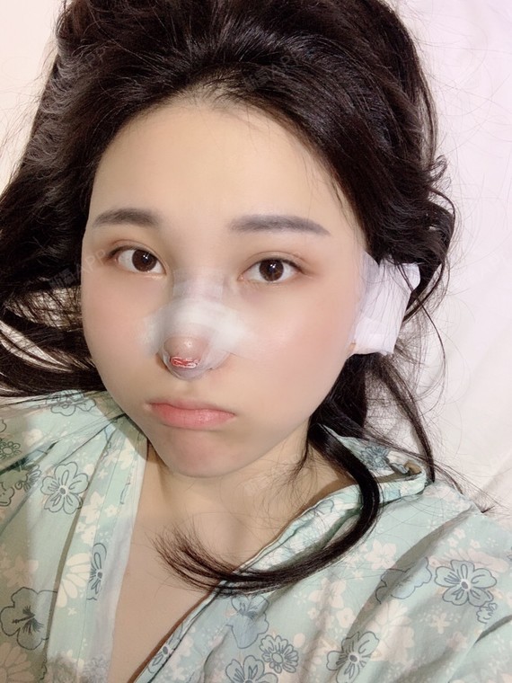 深圳超体隆鼻好不好_效果图_梦玲在这鸭超体隆鼻术后第2天_新氧美容