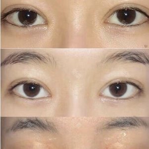 【切开双眼皮】【李氏10°微雕双眼皮】25年眼部精雕技术 眼部口碑