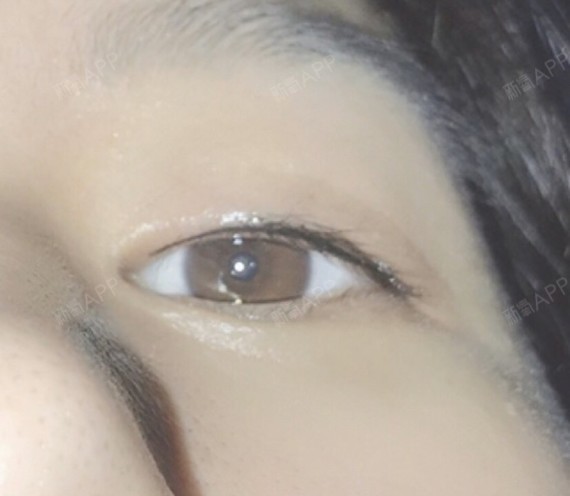 今天做了美瞳线 几年前就流行纹美瞳线- 直很胆怯._圈子-新氧美容整形
