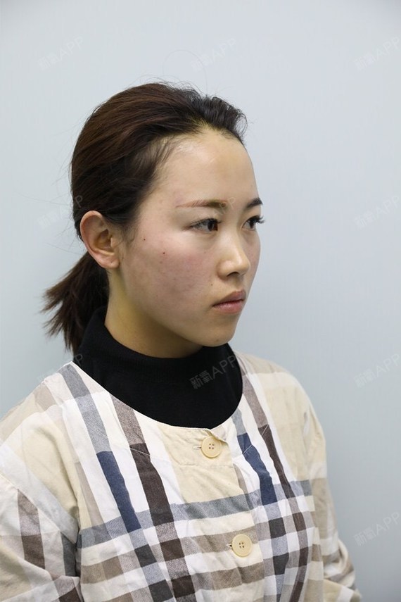 我觉得自己这张大宽脸真的很丑,没有立体感,下颌宽宽_圈子-新氧美容