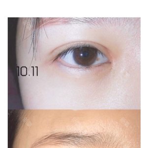 【切开双眼皮】【李氏10°微雕双眼皮】25年眼部精雕技术 眼部口碑