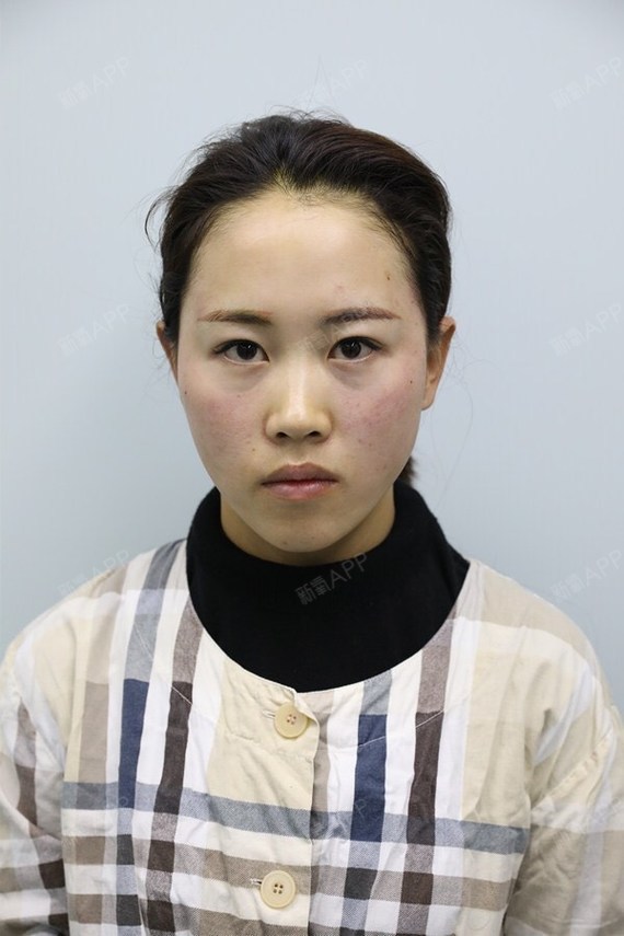 我觉得自己这张大宽脸真的很丑,没有立体感,下颌宽宽_圈子-新氧美容