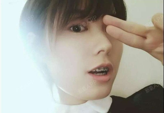 刚带牙套两个月后牙被垫高,咀嚼无力,出现牙套脸了,_圈子-新氧美容