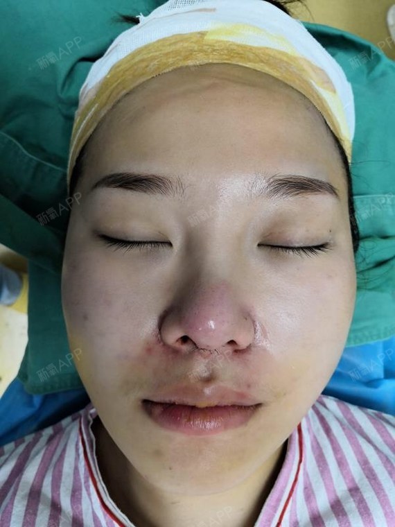 垫鼻基底好不好_效果图_小涵鸭y假体垫鼻基底术后第0天_新氧美容整形