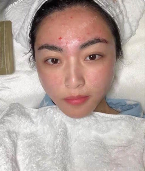 伊肤泉微针好不好_效果图_氧气4ltjz伊肤泉微针术后第13天_新氧美容