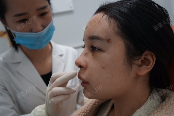 原谅我一直到现在才来更新,很幸运成为朱莎医生的锦鲤,成为了超体隆鼻