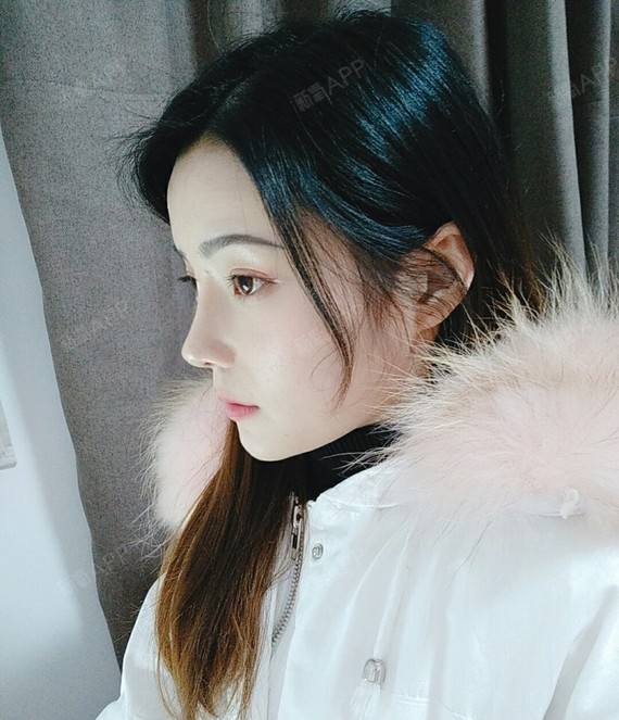 小巧秀气的鼻子就这样子呈现出来了,真的太喜欢我的鼻_圈子-新氧美容