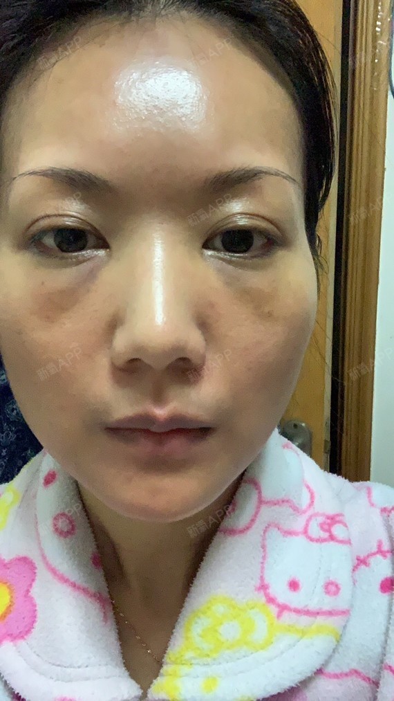 第一天肿的比较厉害,感觉还是有泪沟的感觉,肿的脸都_圈子-新氧美容