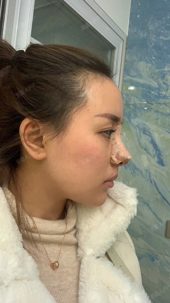 耳软骨复合隆鼻好不好_效果图_涂鸦小屁孩耳软骨复合隆鼻术后第5天