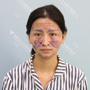 北京乳头缩小好不好_效果图_啦啦啦噜噜噜啦啦啦乳头缩小术后第天