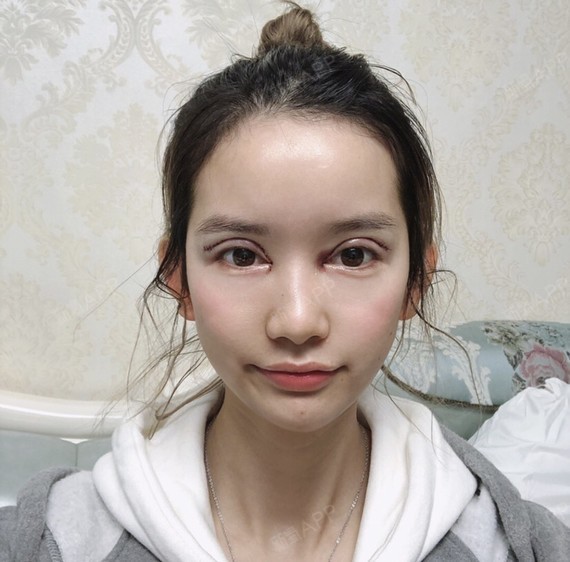 趁过年前去做了一个眼部多项,做的是欧式双眼皮,不知道_圈子-新氧美容