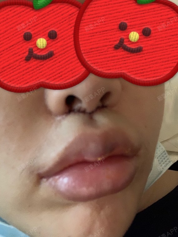 大家好今天是我进行人中嵴重建和人中沟加深的第一天发