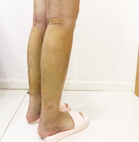 上海吸脂瘦小腿好不好_效果图_hairdown吸脂瘦小腿术后第7天_新氧美容