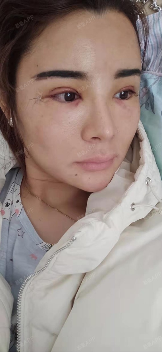 现做了双眼皮和下至,现在眼睛是红红肿肿的,但也还好