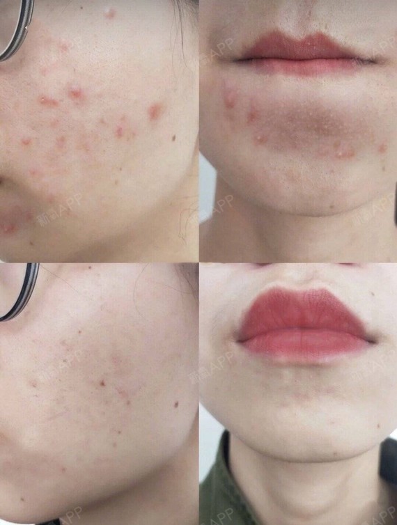 我是针清 红蓝光 水杨酸,幸好选了双均,没有自己粗暴挤痘痘