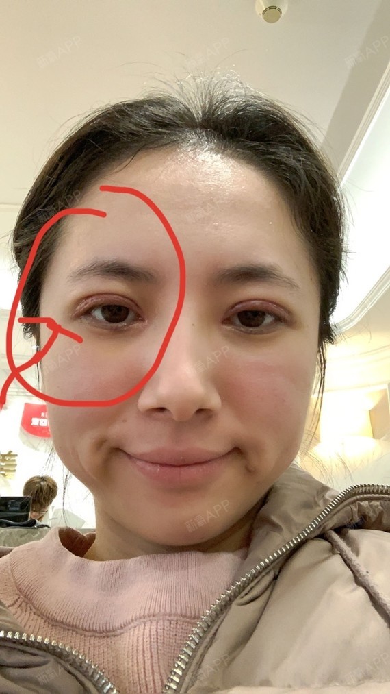 拆线完成,眼尾有点不对称,眼角有点褶皱,希望以后会变得越来