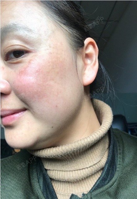 郑州激光祛斑好不好_效果图_氧气5t7b4激光祛斑术后第8天_新氧美容