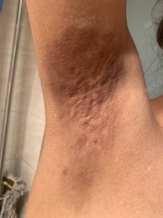 术后三个多月了,腋下还是一大块嘿嘿的,疙疙瘩瘩的摸_圈子-新氧美容