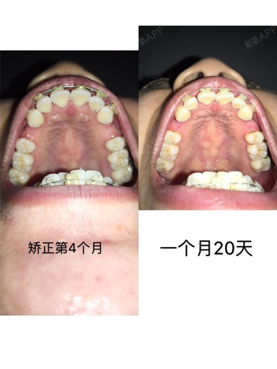 感觉四个月了,已经开始怀疑我这正畸大夫的水平了