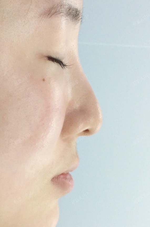 这是第四次做鼻子了 第一次:做的微晶瓷,很早之前做_圈子-新氧美容