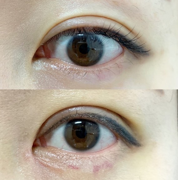 多项手术轻度疼痛眼形美化医生查看皇甫宗演个案例暂无评分眼部整形