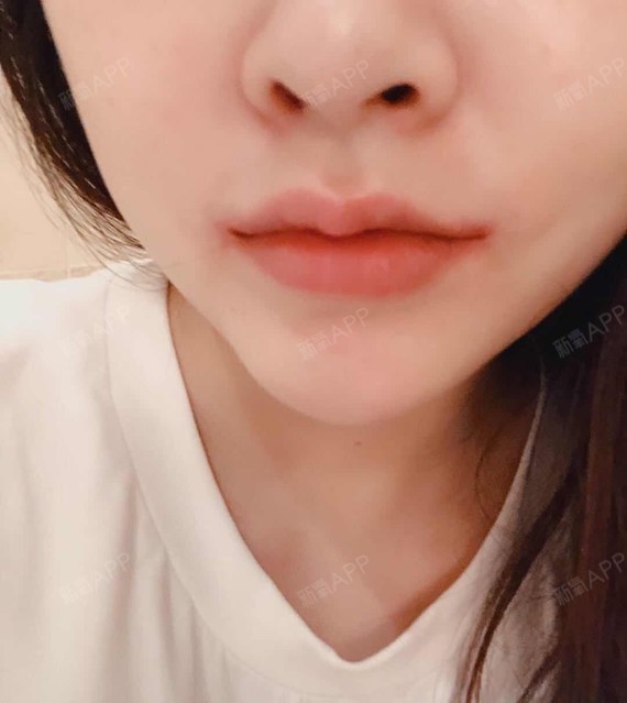 更新一下【嘴角上扬150天变化】,每个人的情况不同_圈子-新氧美容整形