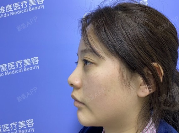 哈喽,给大家分享我的异体骨隆鼻修复日记.平时