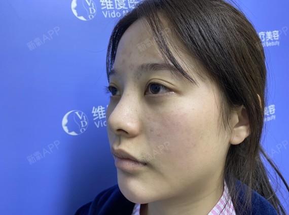 哈喽,给大家分享我的异体骨隆鼻修复日记.平时