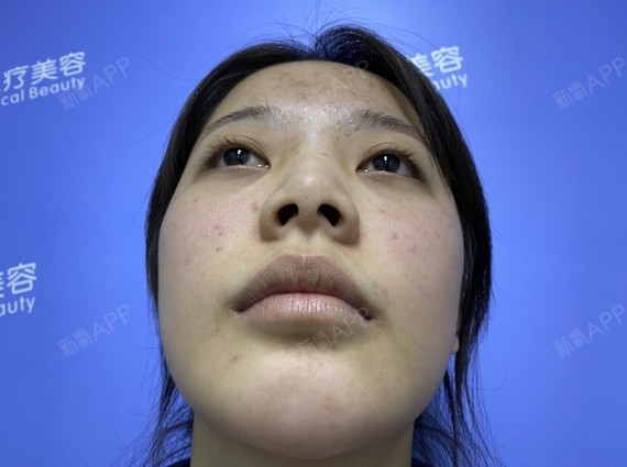 哈喽,给大家分享我的异体骨隆鼻修复日记.平时