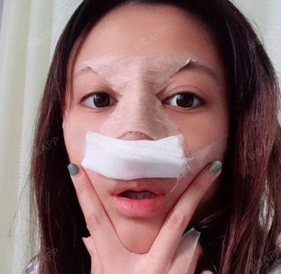 郑州肋软骨隆鼻好不好_效果图_氧气5z155肋软骨隆鼻术后第3天_新氧