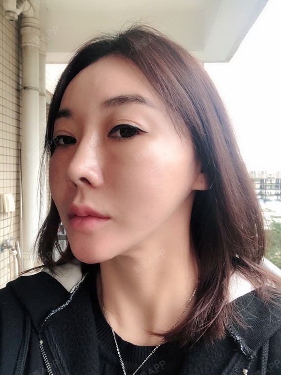 已经术后快两个月了 耳朵处的疤痕完全看不见了90 脸_圈子-新氧美容