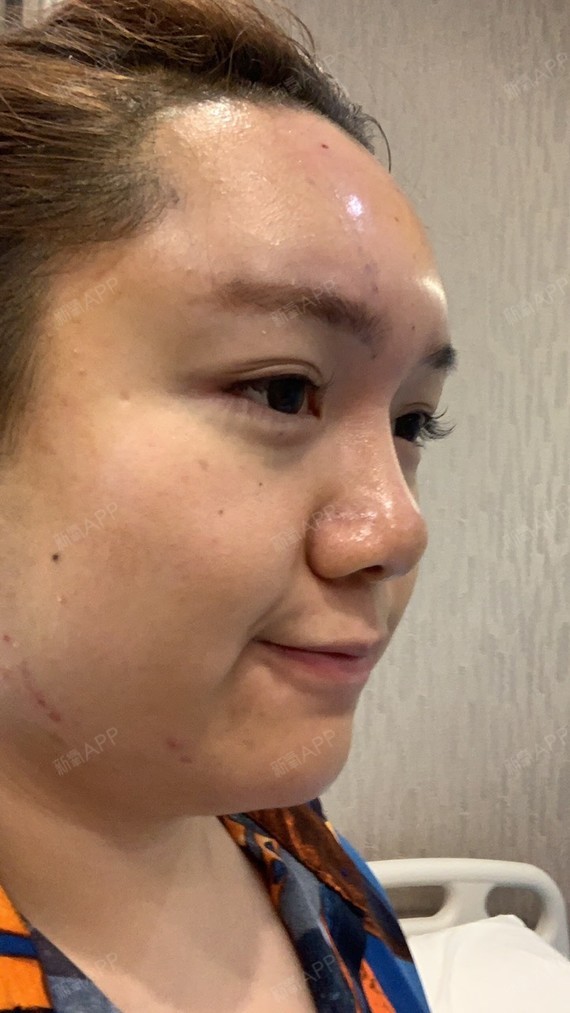 自体脂肪填充额头