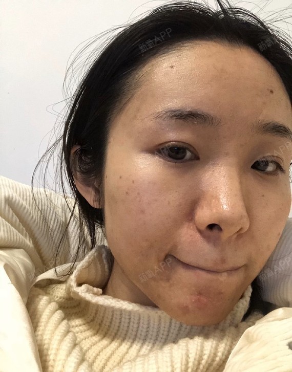 激光印我差不多是10天左右才退的比较多,退之前一直感觉皮肤暗暗黄黄