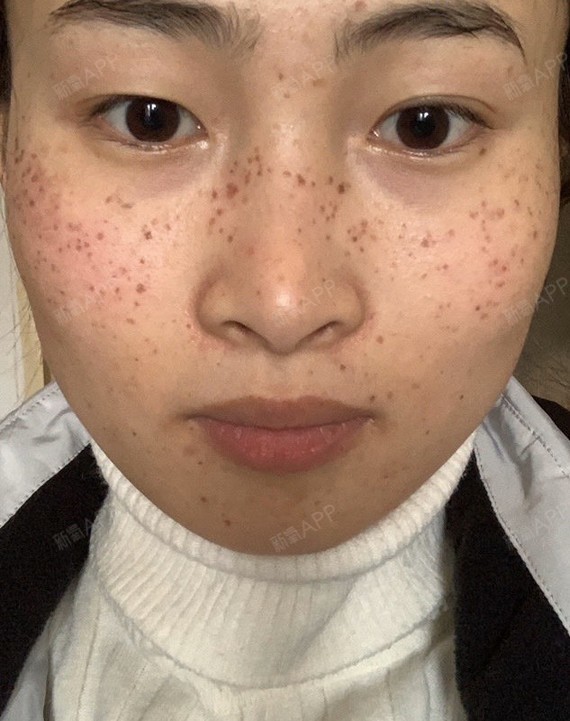 我脸上的斑是遗传雀斑,几岁的时候就开始慢慢有了.