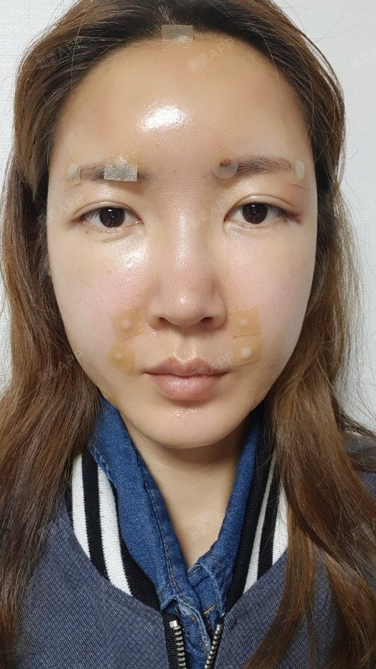 自体脂肪填充全脸