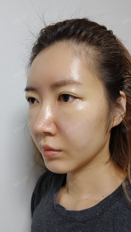 自体脂肪全脸填充好不好_效果图_iu小透明呀自体脂肪全脸填充术后第7