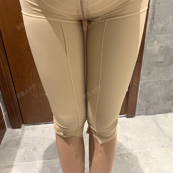 青岛华颜美黄金微雕瘦大腿术后第6天