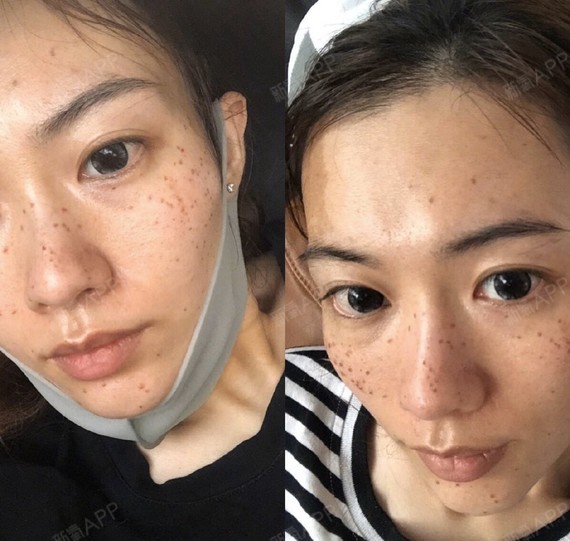 98激光祛斑不会造成皮肤变薄,皮肤有一个修复的过程,_圈子-新氧美容