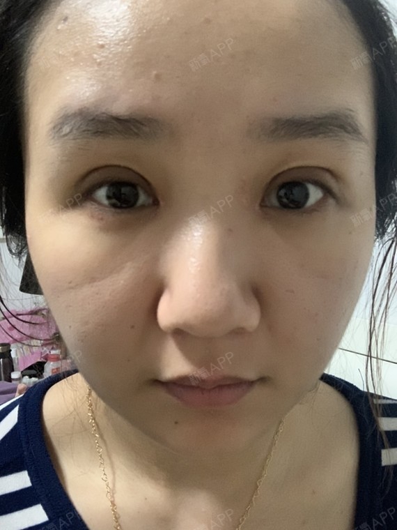 医生跟我说拆线之后一个月不能化妆.一个月不_圈子-新氧美容整形