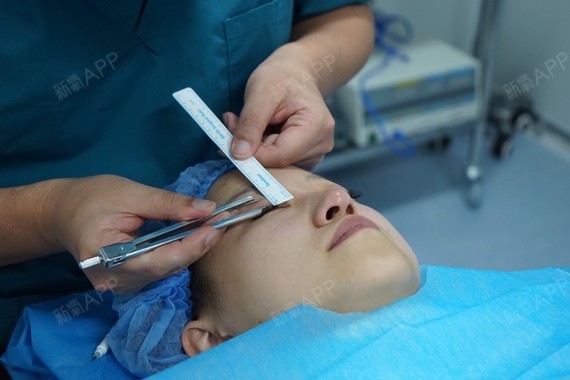 埋线双眼皮手术当天