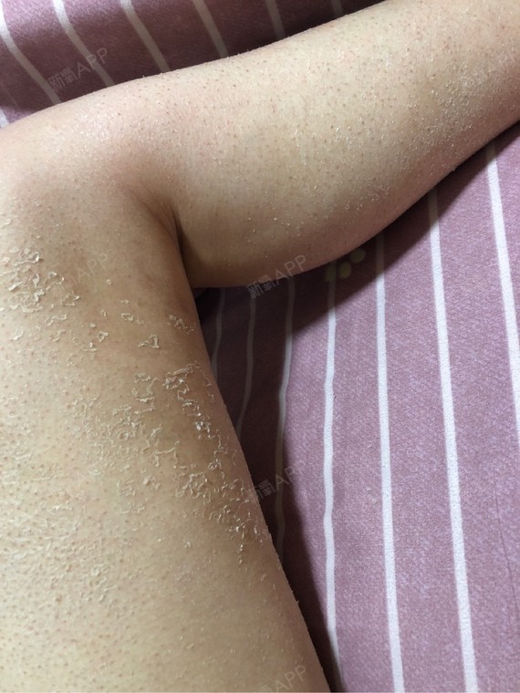 目前状态:腿围没有再变化,继续严重脱皮,皮肤粗糙;大腿