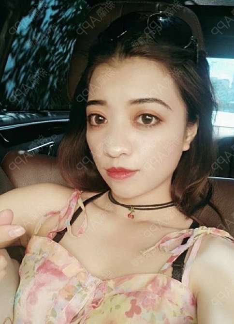 鼻部多项好不好_效果图_氧气5jj6j鼻部多项术后第0天_新氧美容整形